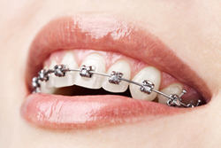 orthodontic treatment toronto markham